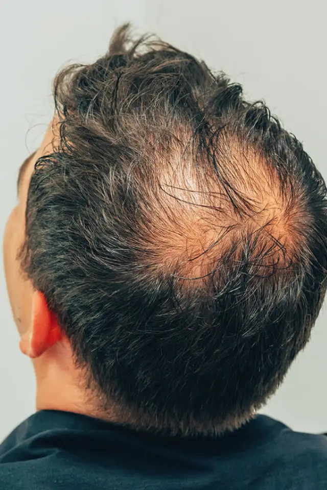 Androgenetic Alopecia Solutions