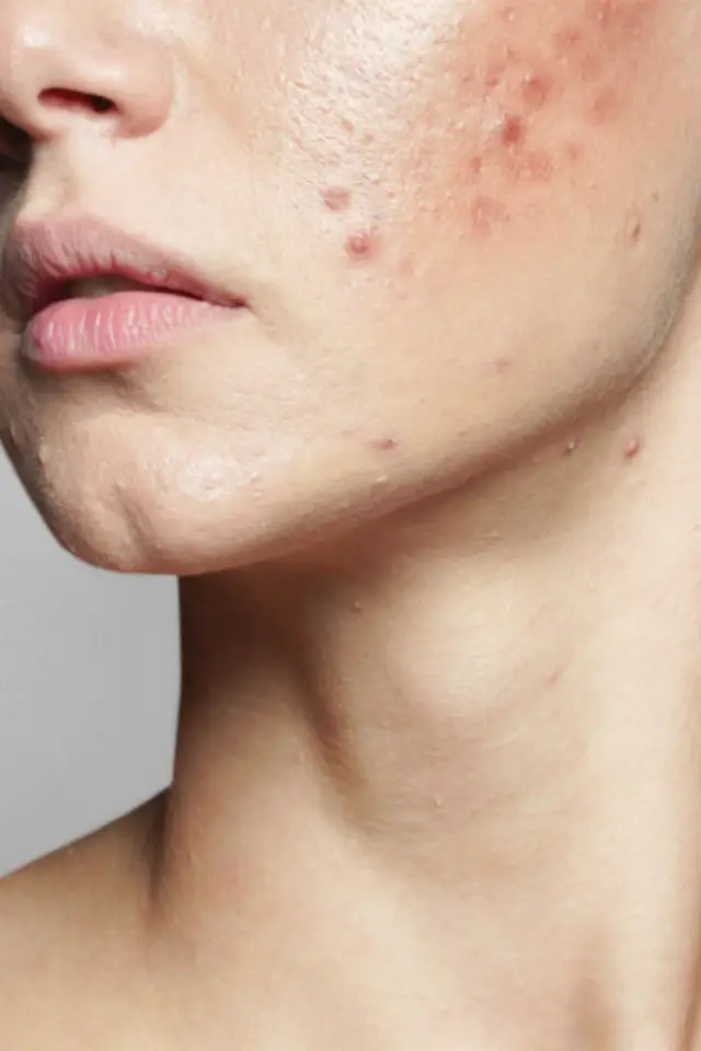 Any scar over the body treatment