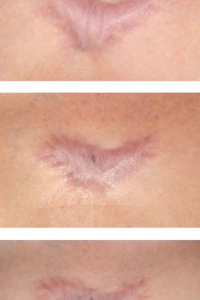 Keloid/ hypertrophic scar treatment