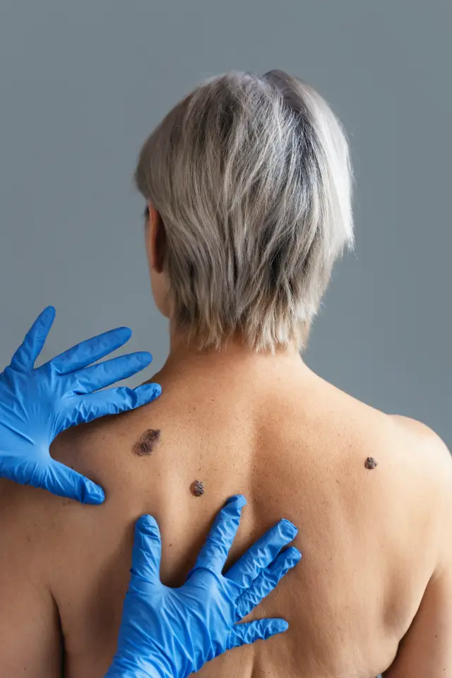 Mole removal