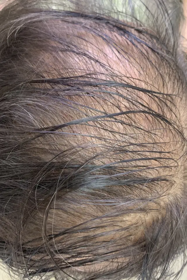 Trichology-led Hair Loss Diagnosis
