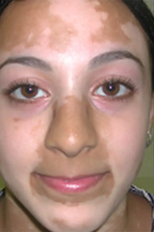 Vitiligo surgery