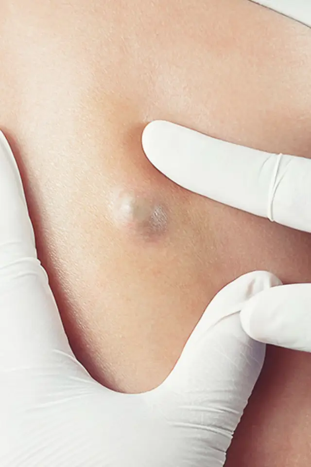 sebaceous cyst excision